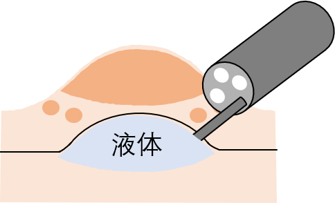 治療消化道早期腫瘤的“利器”——內(nèi)鏡下粘膜剝離術(shù)（ESD）