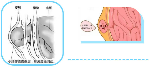 勿以“疝”小而不為：正確認(rèn)識(shí)腹股溝疝