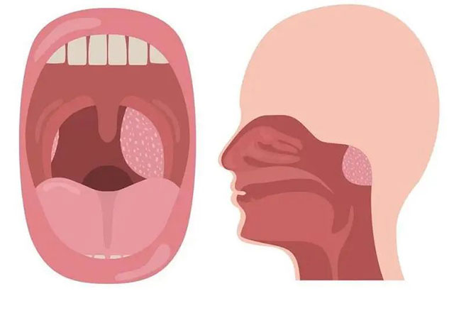 娃睡覺張嘴，打呼嚕？警惕腺樣體肥大