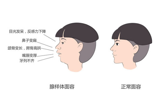 娃睡覺張嘴，打呼嚕？警惕腺樣體肥大