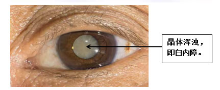 關(guān)于白內(nèi)障，這些知識(shí)幫父母了解!