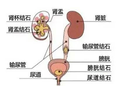 夏天來(lái)了，泌尿系結(jié)石又搞“偷襲”？