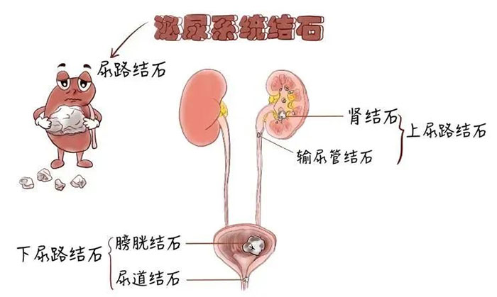 夏天來(lái)了，泌尿系結(jié)石又搞“偷襲”？