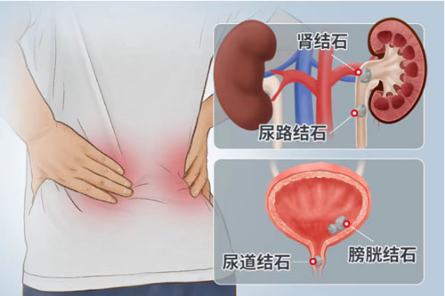 尿路結(jié)石痛不欲生？專家教你一招搞定！