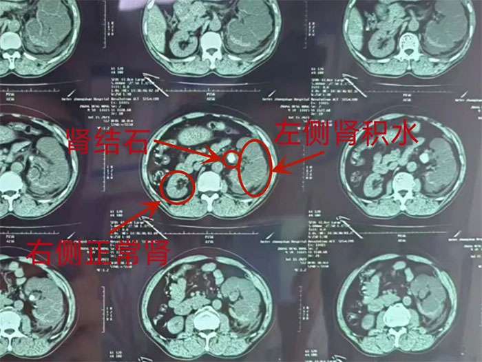 小小結(jié)石竟然讓人丟掉一個(gè)腎？體檢查出腎結(jié)石怎么辦？