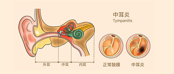 耳朵不舒服，是不是得中耳炎了？出現(xiàn)這些征兆要注意了