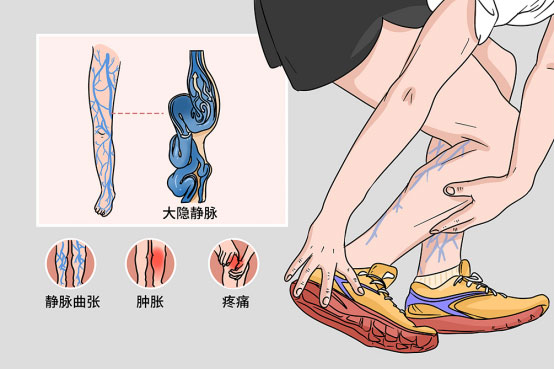 “蚯蚓腿”怎么辦？醫(yī)生：試試這幾種辦法