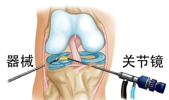 【骨科微創(chuàng)】關(guān)節(jié)鏡——關(guān)節(jié)問題患者的福音