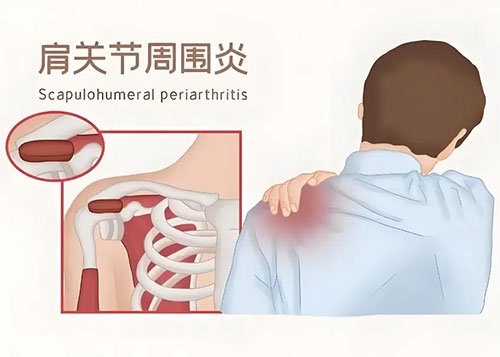 【惠民科普】別讓“鐵肩”成為你生活的“絆腳石”