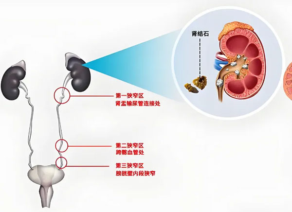 不可小“瞧”的健康絆腳石——輸尿管結(jié)石